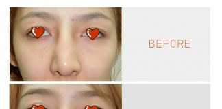 เสริมจมูก