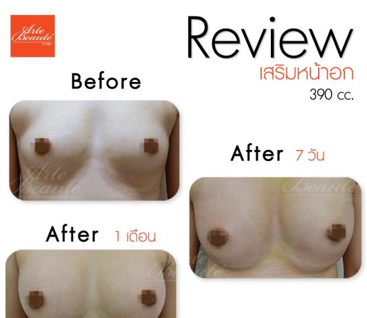 เสริมหน้าอก ทำนม ทำหน้าอก ทำนม