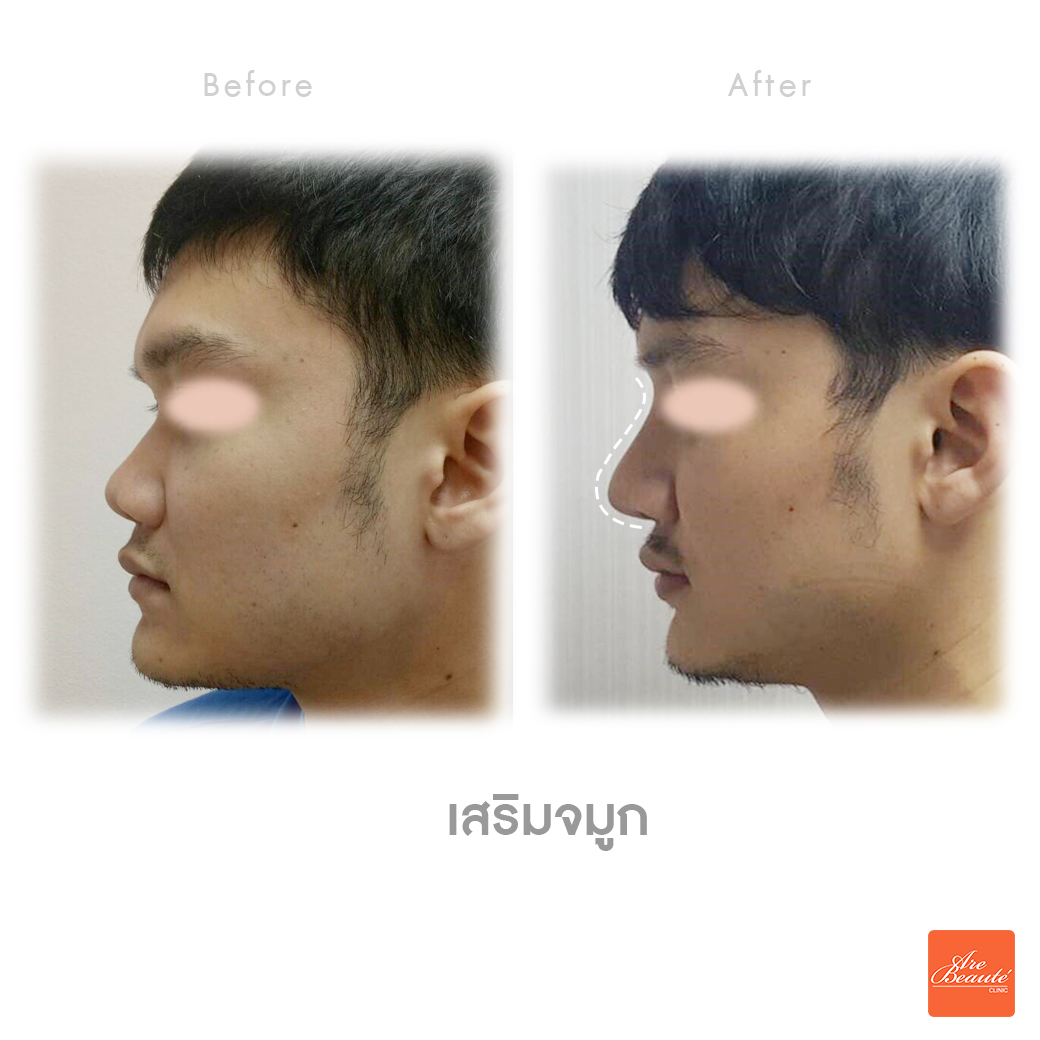 before after แปลว่า