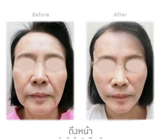 ก่อน-หลัง ดึงหน้า (หลังทำ 1เดือน)